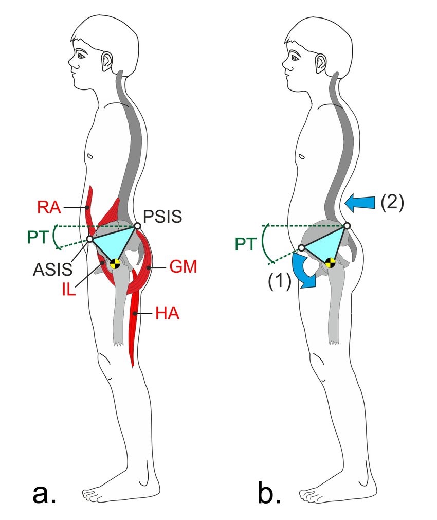 Anterior Pelvic Tilt, Hamstring Strains, and the Pelvis as a Strain Regulator
