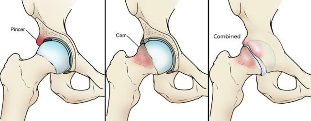 Femoroacetabular Impingement (FAI): What It Is, Why It Shows Up in Athletes, and How to Coach Around It